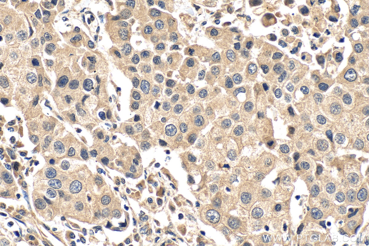 Immunohistochemistry (IHC) staining of human breast cancer tissue using FOXC2 Monoclonal antibody (68384-1-Ig)