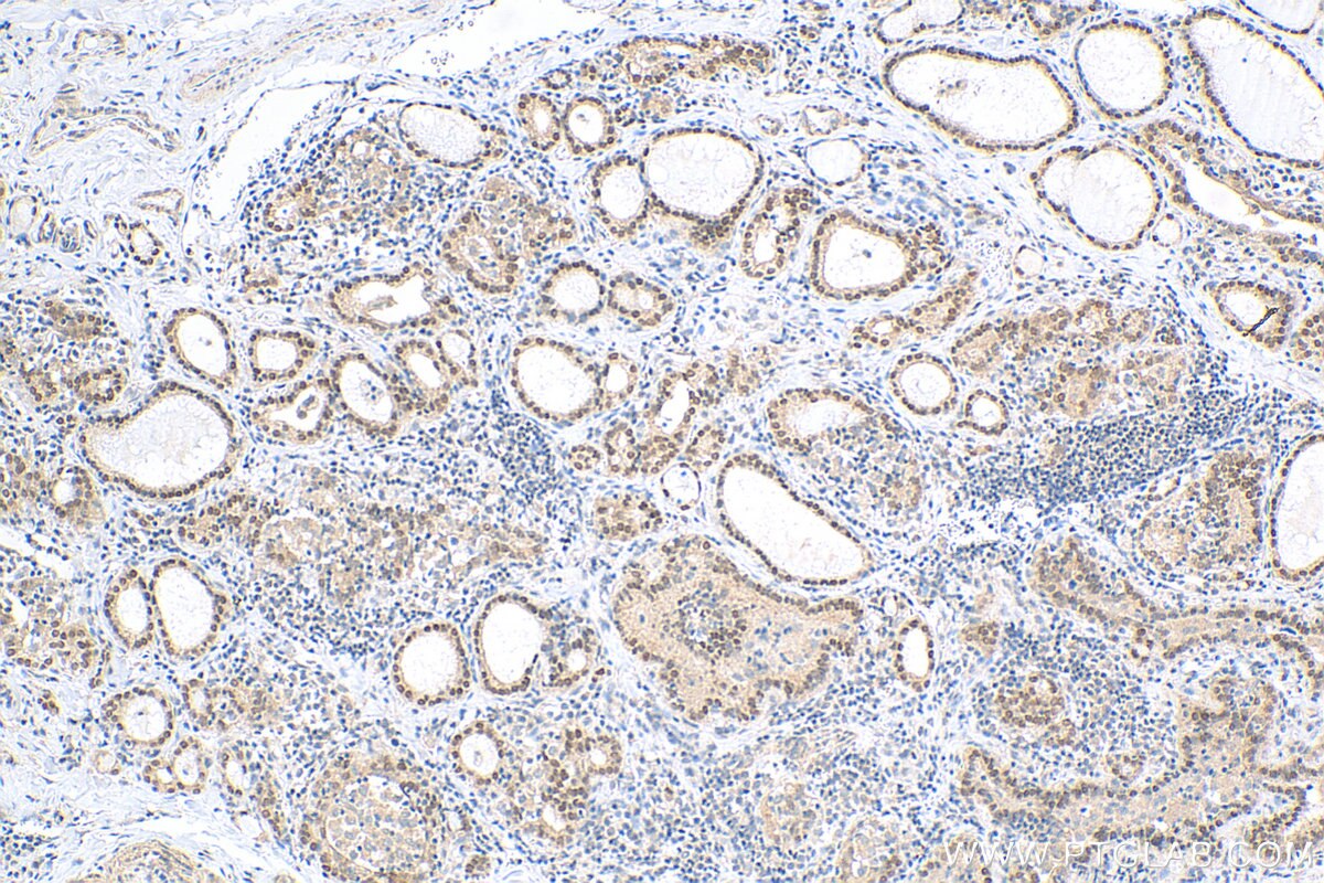 Immunohistochemistry (IHC) staining of human thyroid cancer tissue using FOXE1 Polyclonal antibody (55363-1-AP)