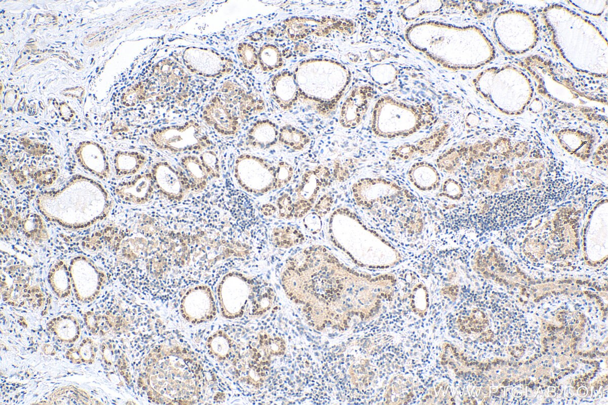 Immunohistochemistry (IHC) staining of human thyroid cancer tissue using FOXE1 Polyclonal antibody (55363-1-AP)