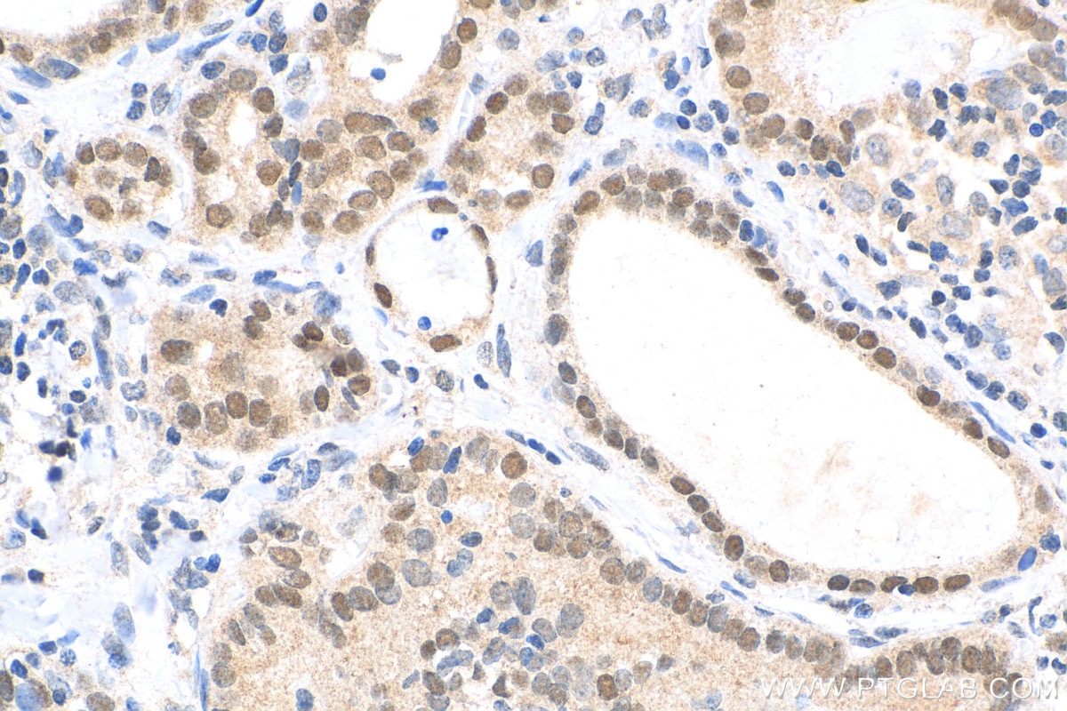 Immunohistochemistry (IHC) staining of human thyroid cancer tissue using FOXE1 Polyclonal antibody (55363-1-AP)