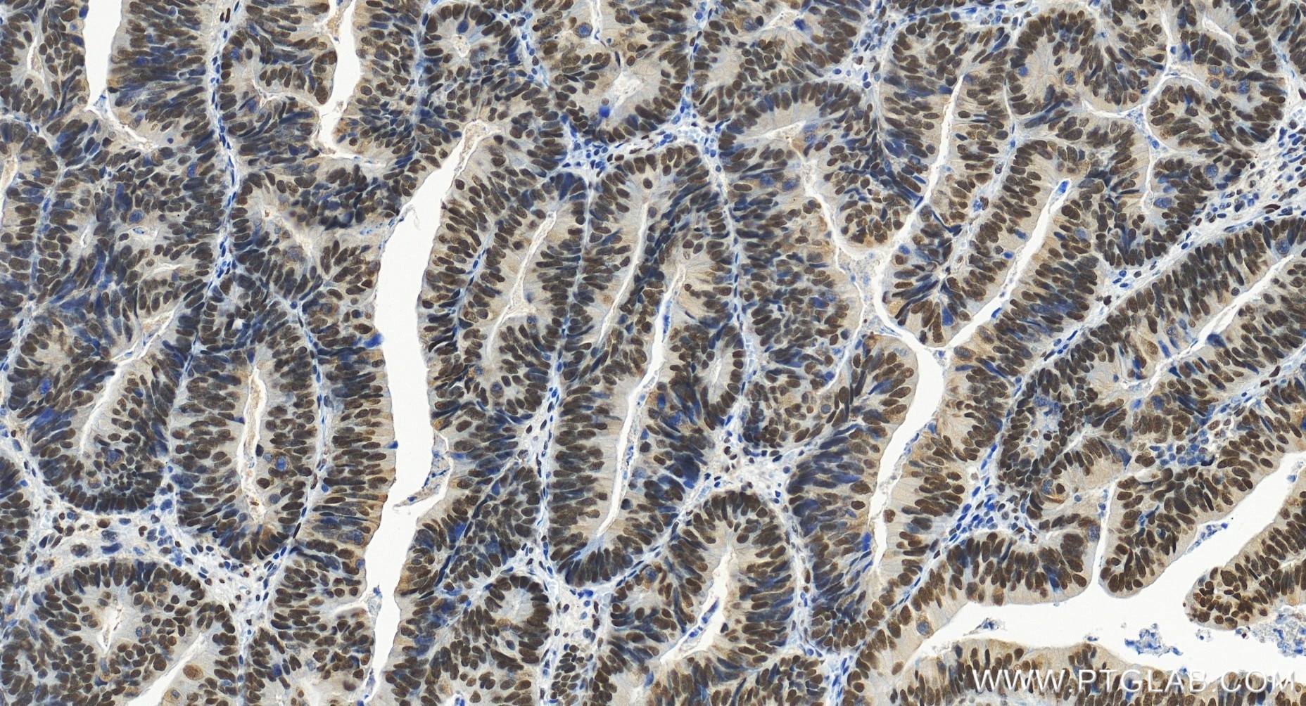 Immunohistochemistry (IHC) staining of human colon cancer tissue using FOXK1 Recombinant antibody (86452-1-RR)