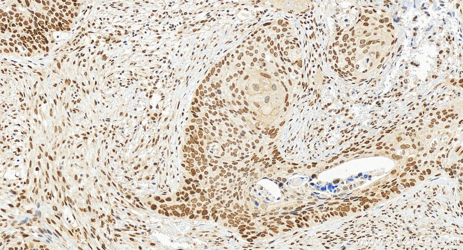Immunohistochemical analysis of paraffin-embedded human cervical squamous cancer tissue slide using 30660-1-AP (FOXK2 antibody) at dilution of 1:1000 (under 20x lens). Heat mediated antigen retrieval with Tris-EDTA buffer (pH 9.0). Immunohistochemistry (IHC) staining of human cervical squamous cancer tissue using FOXK2 Polyclonal antibody (30660-1-AP)