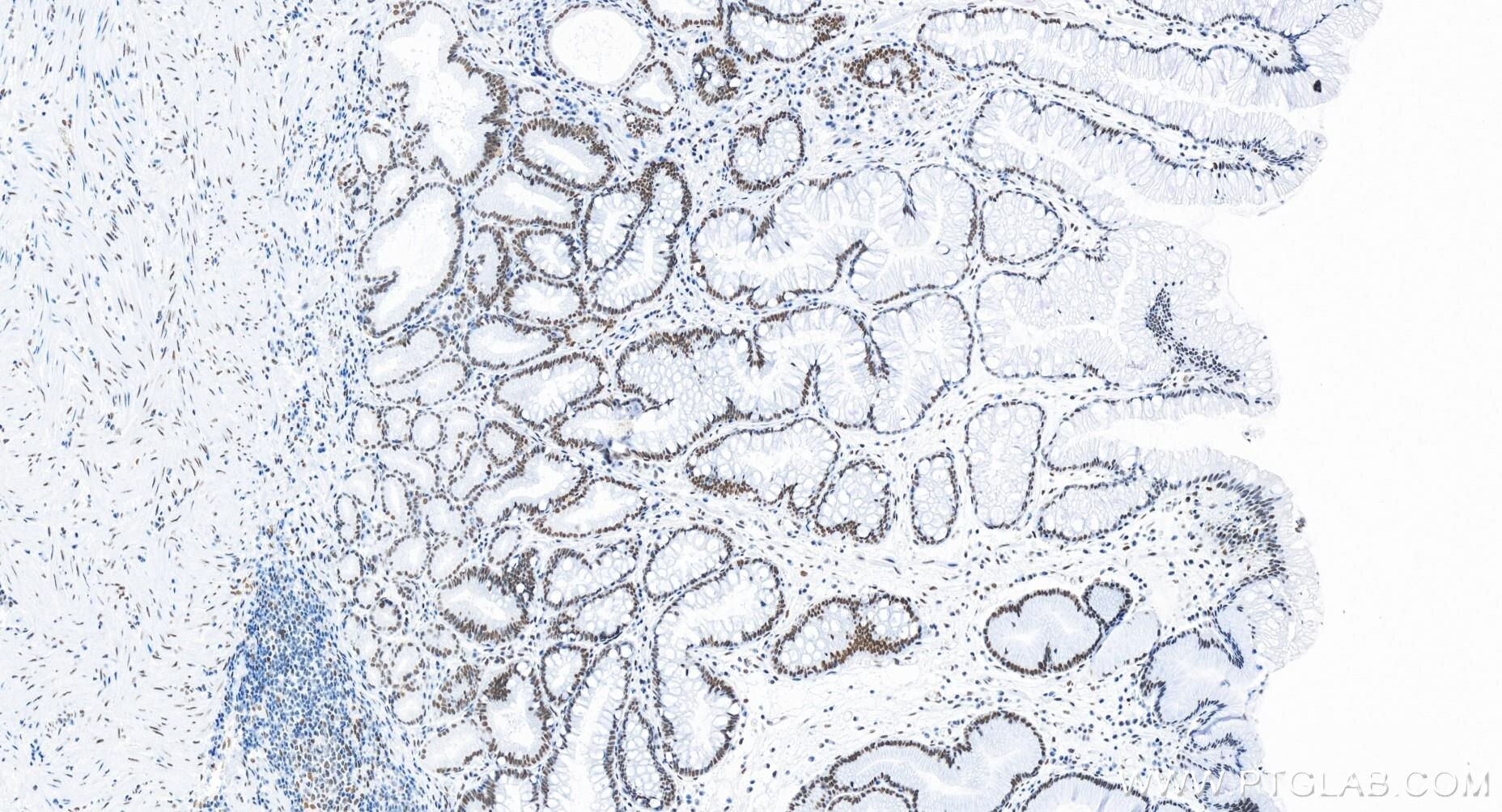 Immunohistochemistry (IHC) staining of human stomach cancer tissue using FOXK2 Recombinant antibody (83735-6-RR)