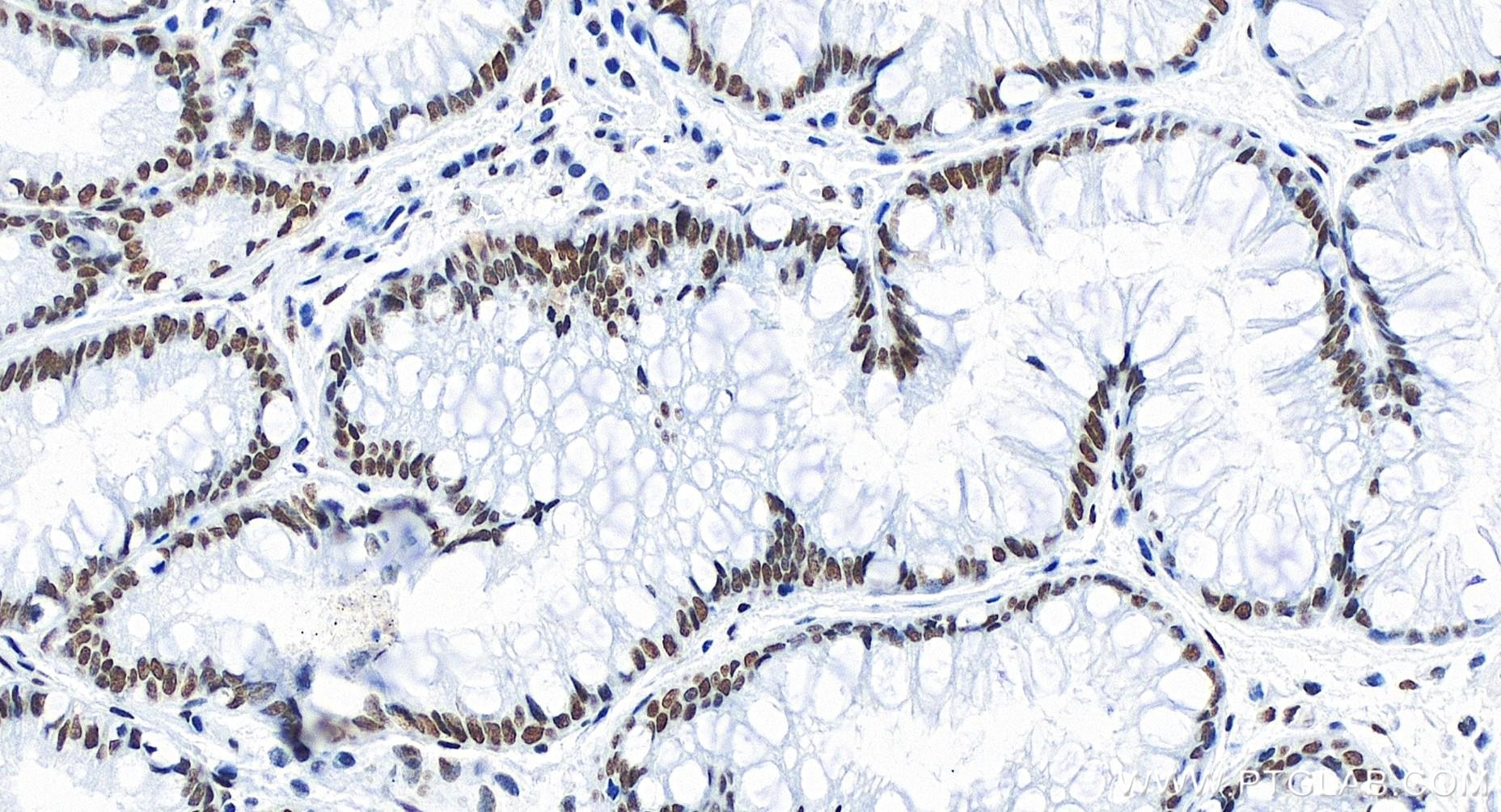 Immunohistochemistry (IHC) staining of human stomach cancer tissue using FOXK2 Recombinant antibody (83735-6-RR)
