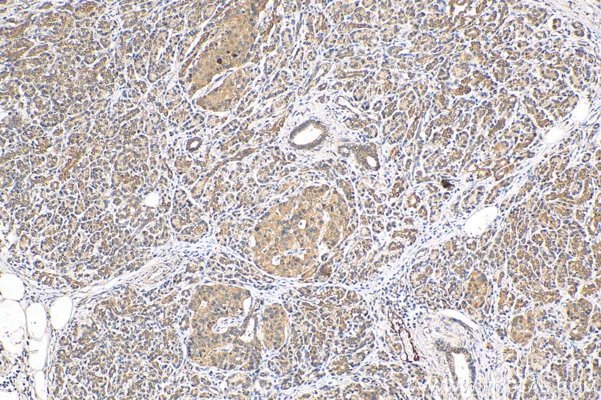 IHC staining of human pancreas cancer using 13147-1-AP