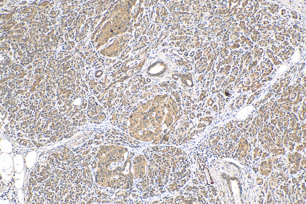 IHC staining of human pancreas cancer using 13147-1-AP