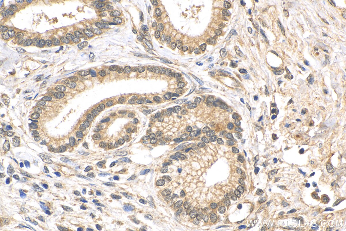 Immunohistochemistry (IHC) staining of human pancreas cancer tissue using FOXM1 Polyclonal antibody (13147-1-AP)