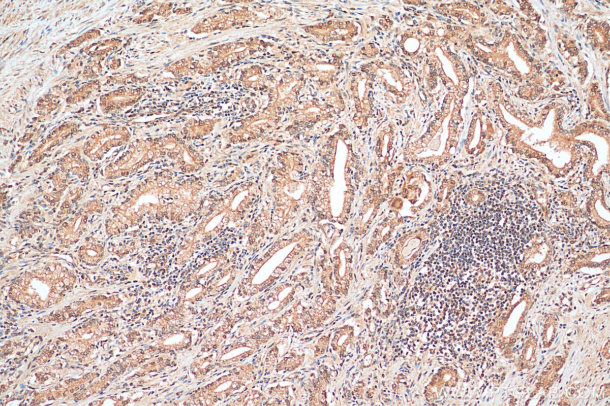 IHC staining of human prostate cancer using 18592-1-AP