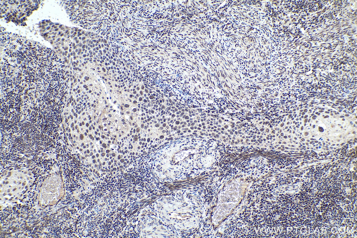 Immunohistochemistry (IHC) staining of human cervical cancer tissue using FOXO1 Monoclonal antibody (66457-1-Ig)