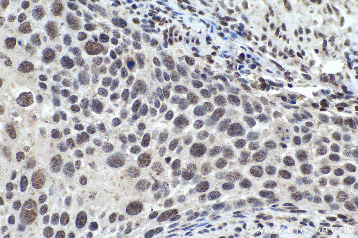 Immunohistochemistry (IHC) staining of human cervical cancer tissue using FOXO1 Monoclonal antibody (66457-1-Ig)