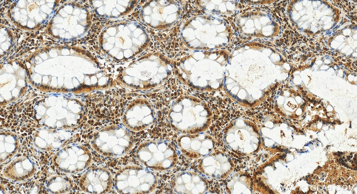 Immunohistochemistry (IHC) staining of human colon cancer tissue using FOXO3A Polyclonal antibody (10849-1-AP)