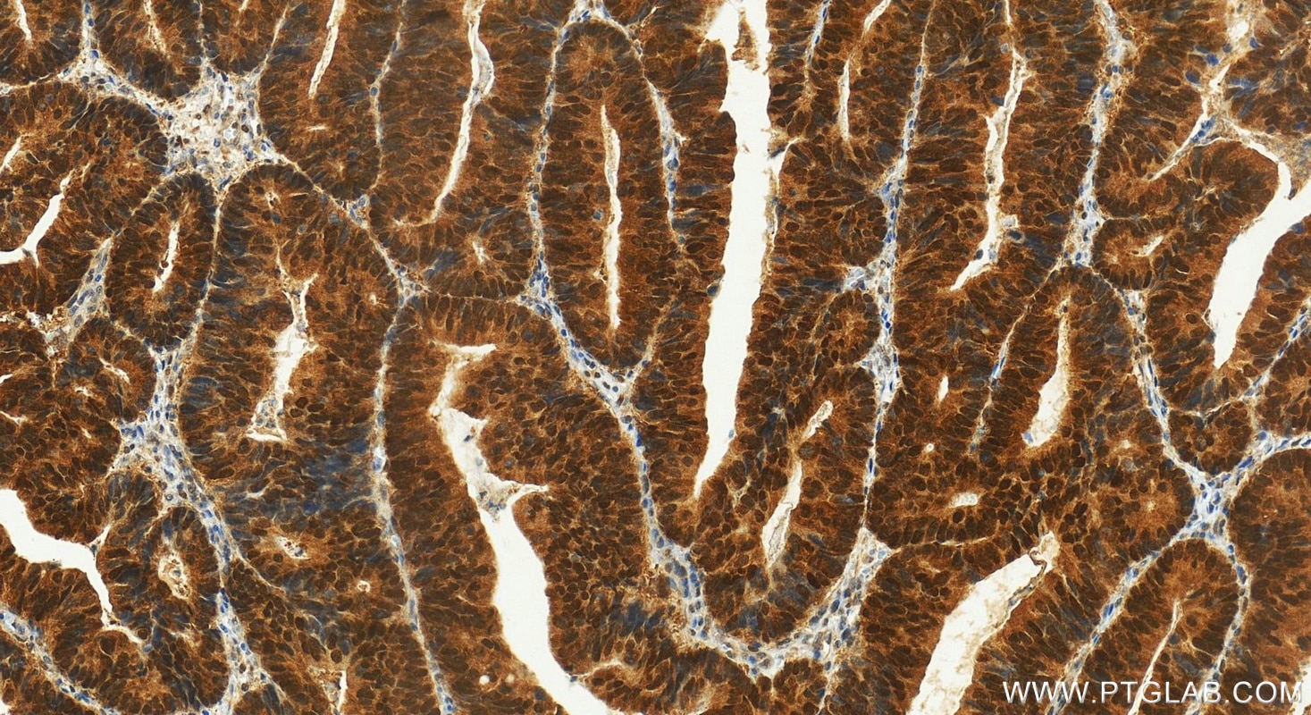 Immunohistochemistry (IHC) staining of human colon cancer tissue using FOXO3A Polyclonal antibody (10849-1-AP)