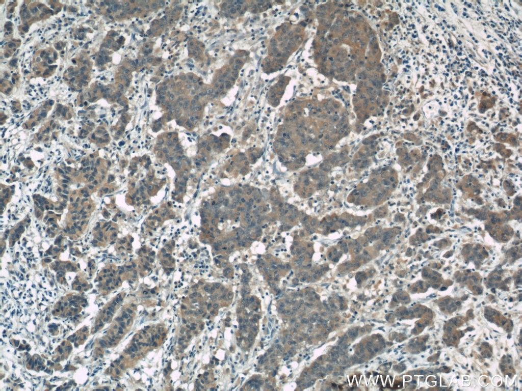 Immunohistochemistry (IHC) staining of human prostate cancer tissue using FOXO3A Polyclonal antibody (10849-1-AP)