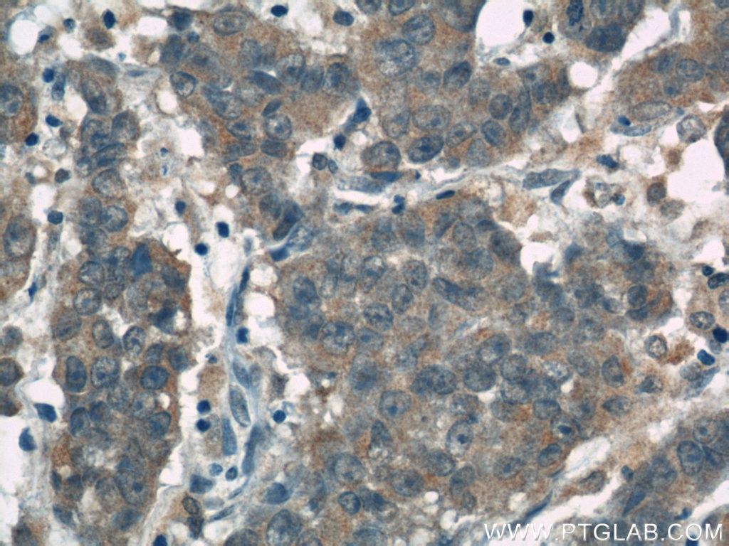 Immunohistochemistry (IHC) staining of human prostate cancer tissue using FOXO3A Polyclonal antibody (10849-1-AP)