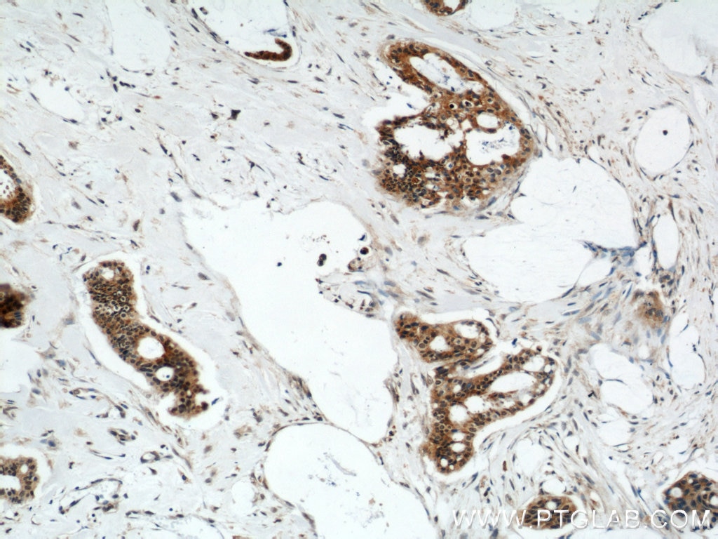 Immunohistochemistry (IHC) staining of human breast cancer tissue using FOXO3A Polyclonal antibody (10849-1-AP)