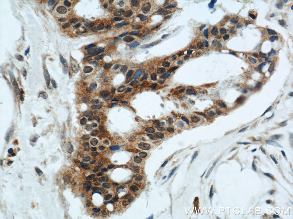 Immunohistochemistry (IHC) staining of human breast cancer tissue using FOXO3A Polyclonal antibody (10849-1-AP)