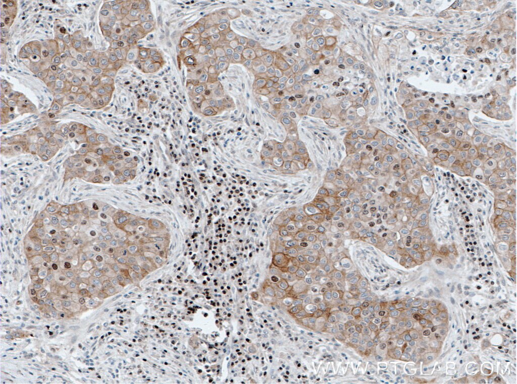 Immunohistochemistry (IHC) staining of human breast cancer tissue using FOXO3A Monoclonal antibody (66428-1-Ig)