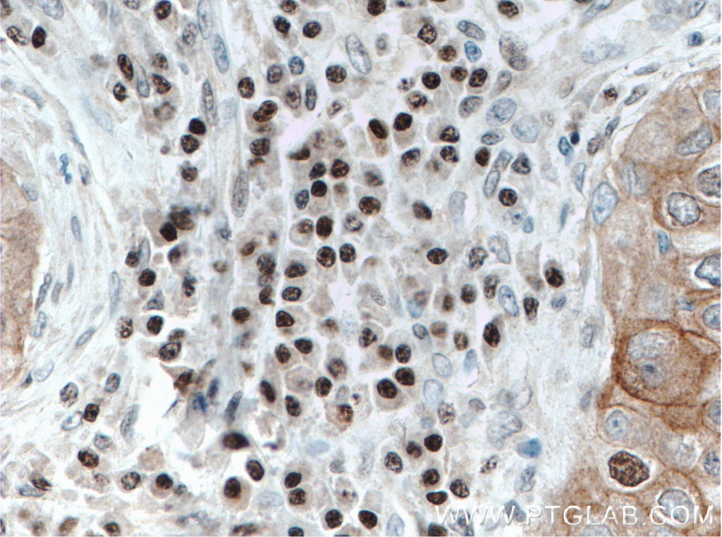 IHC staining of human breast cancer using 66428-1-Ig