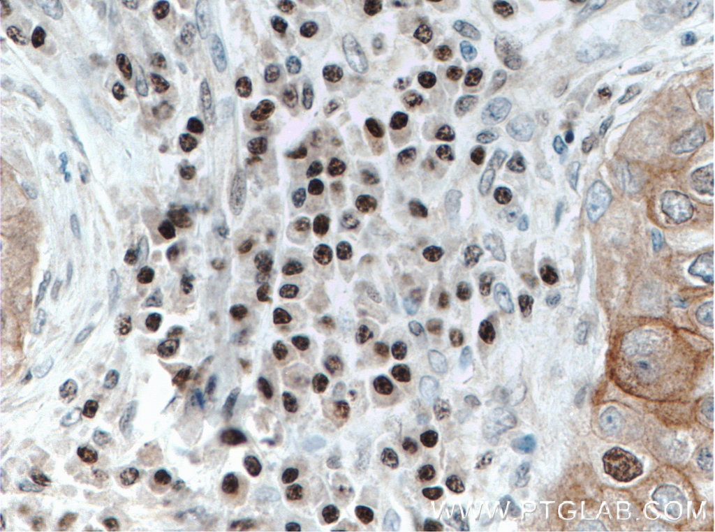 Immunohistochemistry (IHC) staining of human breast cancer tissue using FOXO3A Monoclonal antibody (66428-1-Ig)