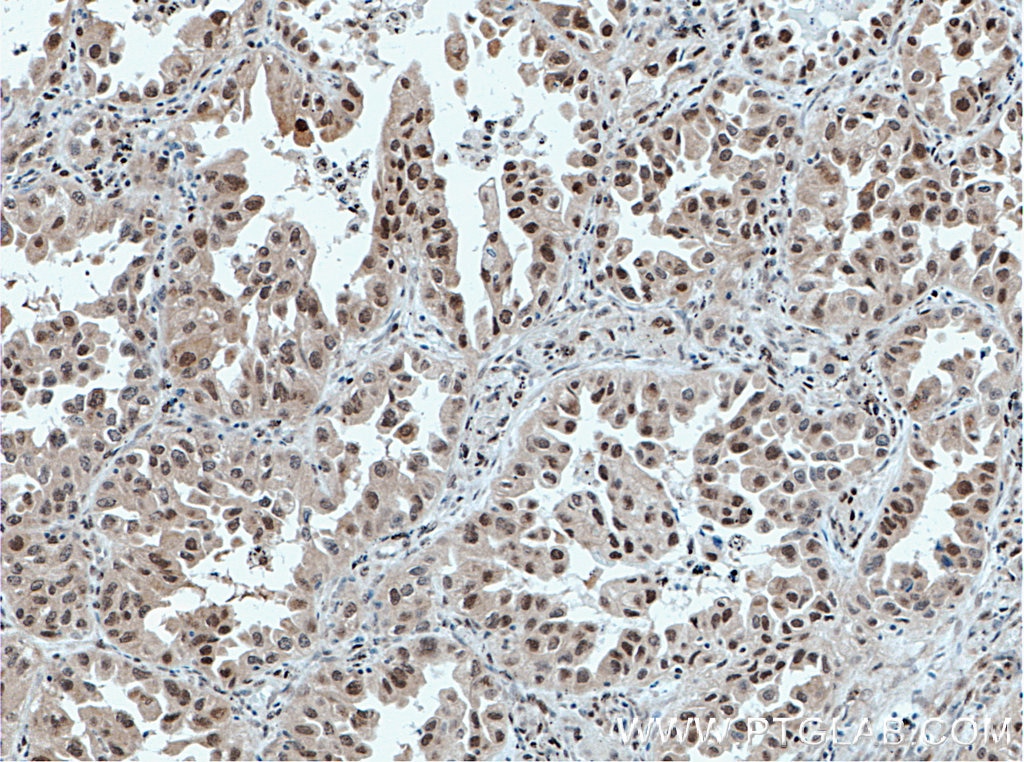 IHC staining of human lung cancer using 66428-1-Ig