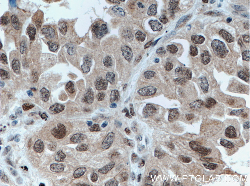 Immunohistochemistry (IHC) staining of human lung cancer tissue using FOXO3A Monoclonal antibody (66428-1-Ig)