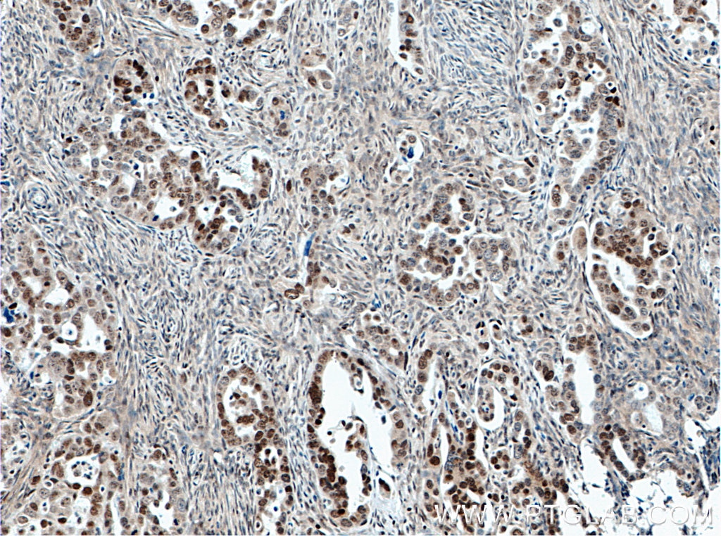 Immunohistochemistry (IHC) staining of human ovary tumor tissue using FOXO3A Monoclonal antibody (66428-1-Ig)