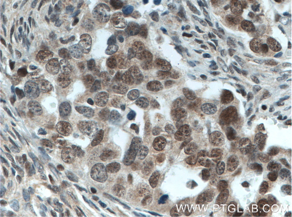 Immunohistochemistry (IHC) staining of human ovary tumor tissue using FOXO3A Monoclonal antibody (66428-1-Ig)