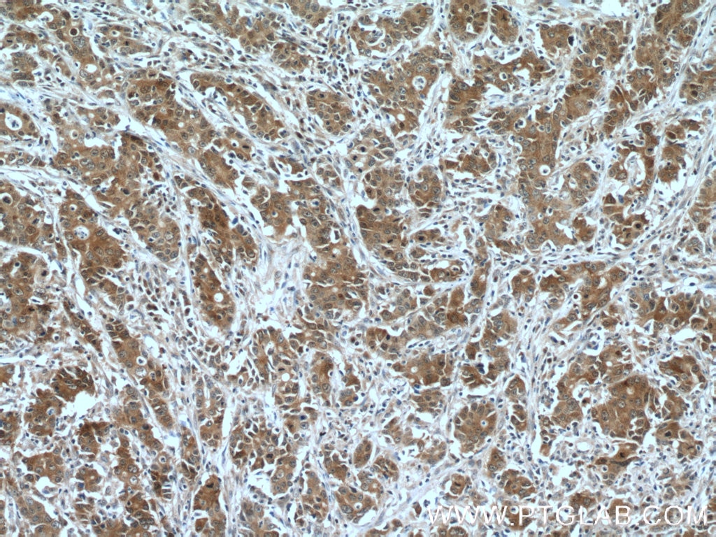 Immunohistochemistry (IHC) staining of human stomach cancer tissue using FOXO3A Monoclonal antibody (66428-1-Ig)