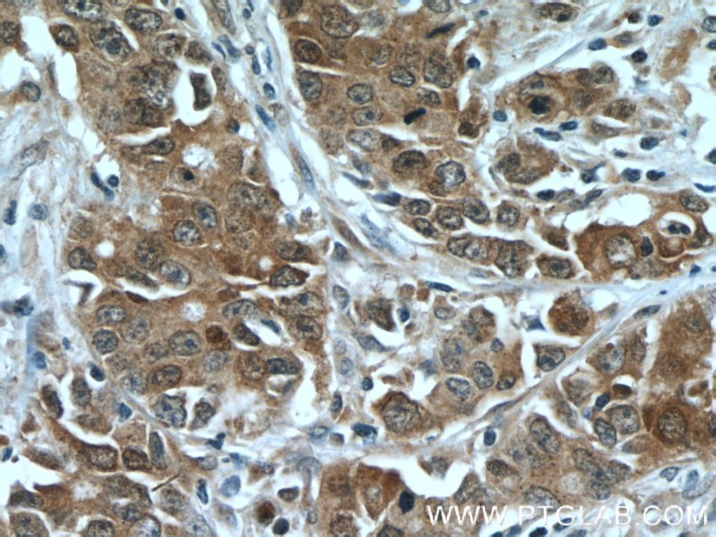 Immunohistochemistry (IHC) staining of human stomach cancer tissue using FOXO3A Monoclonal antibody (66428-1-Ig)