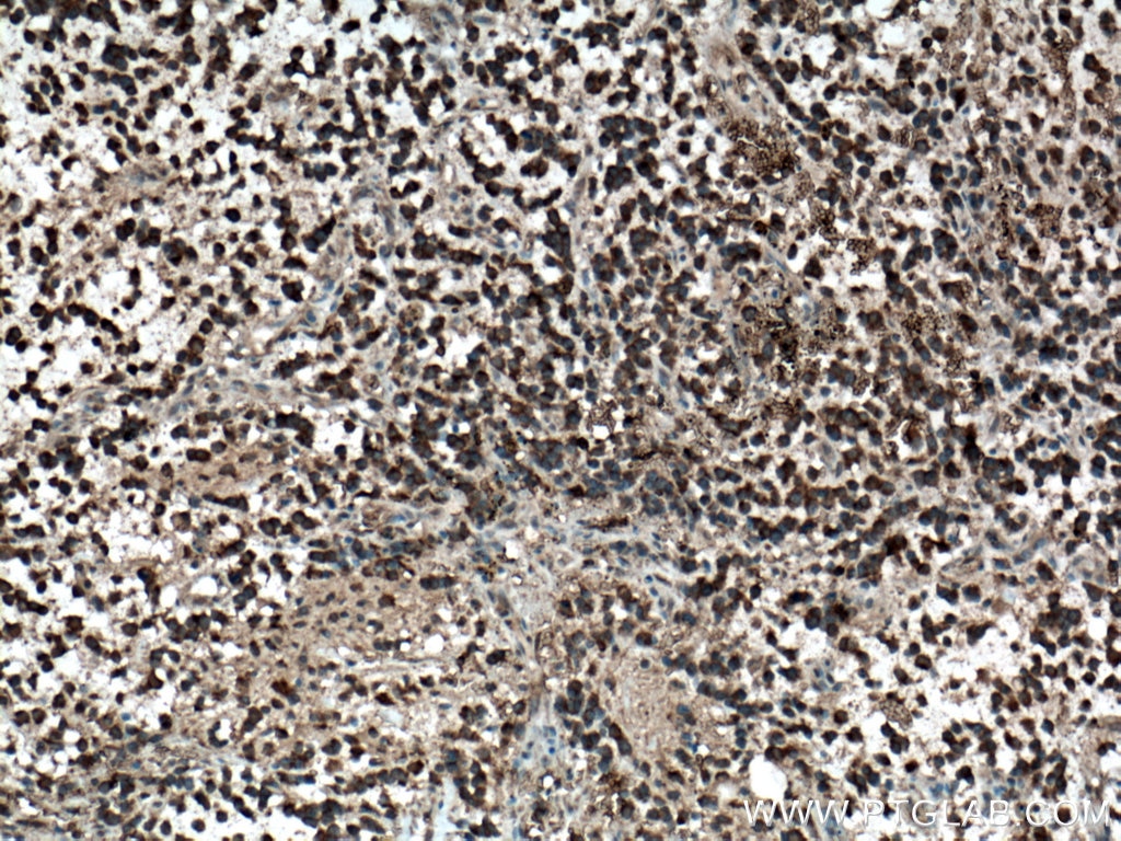 Immunohistochemistry (IHC) staining of human gliomas tissue using FOXO6 Polyclonal antibody (19122-1-AP)