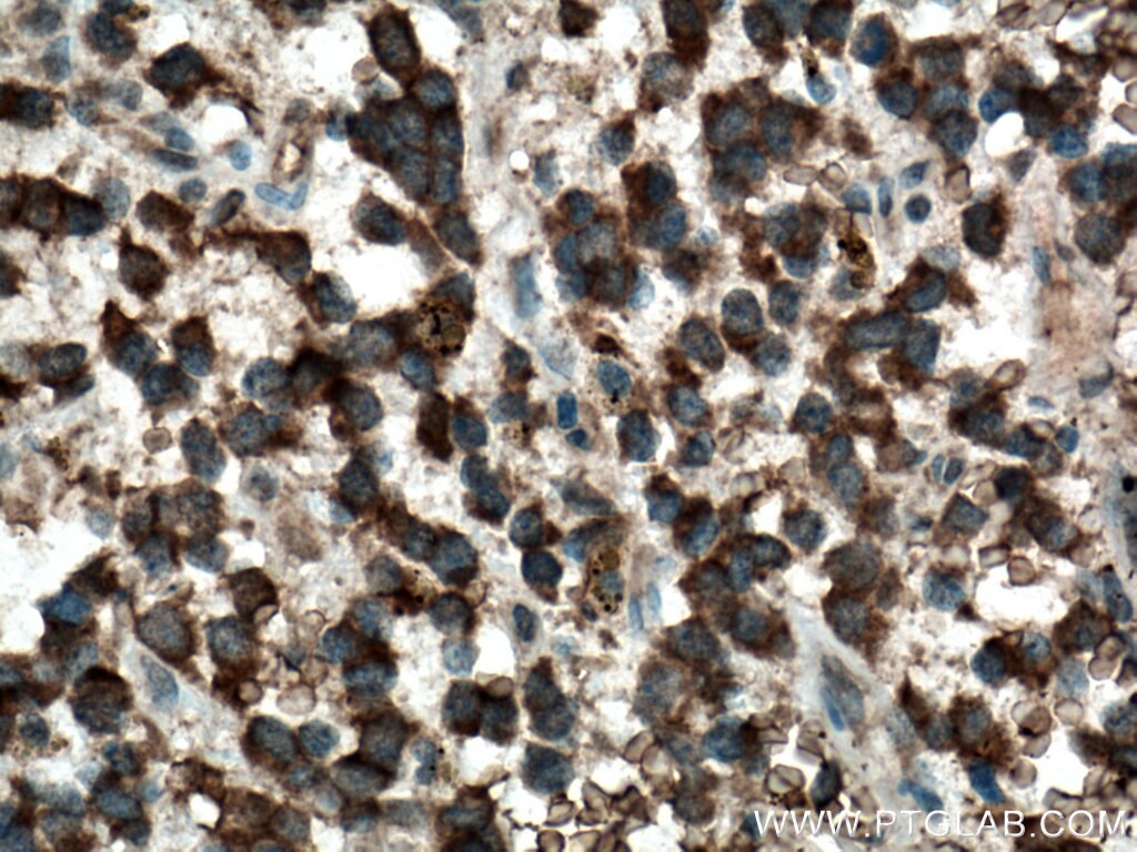 Immunohistochemistry (IHC) staining of human gliomas tissue using FOXO6 Polyclonal antibody (19122-1-AP)