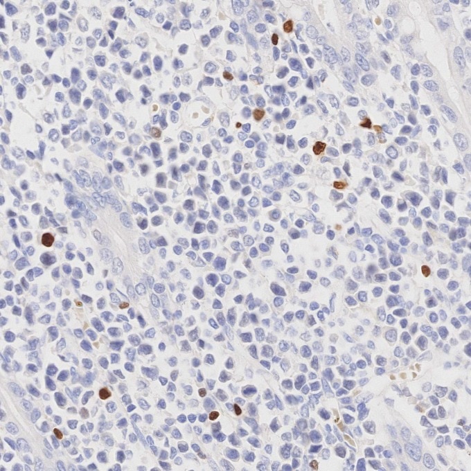 Immunohistochemistry (IHC) staining of human lymphoma tissue using FOXP3 Monoclonal antibody (68803-2-Ig)