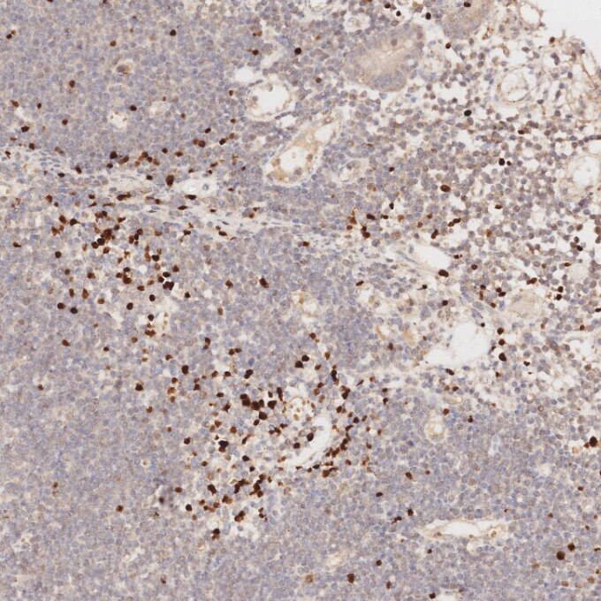 Immunohistochemistry (IHC) staining of human lymphoma tissue using FOXP3 Monoclonal antibody (68803-2-Ig)