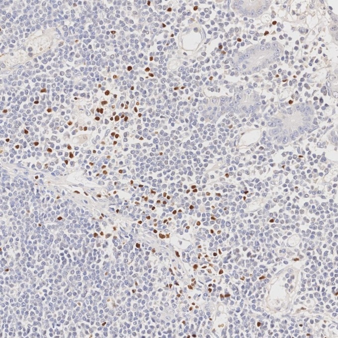 Immunohistochemistry (IHC) staining of human lymphoma tissue using FOXP3 Monoclonal antibody (68803-2-Ig)