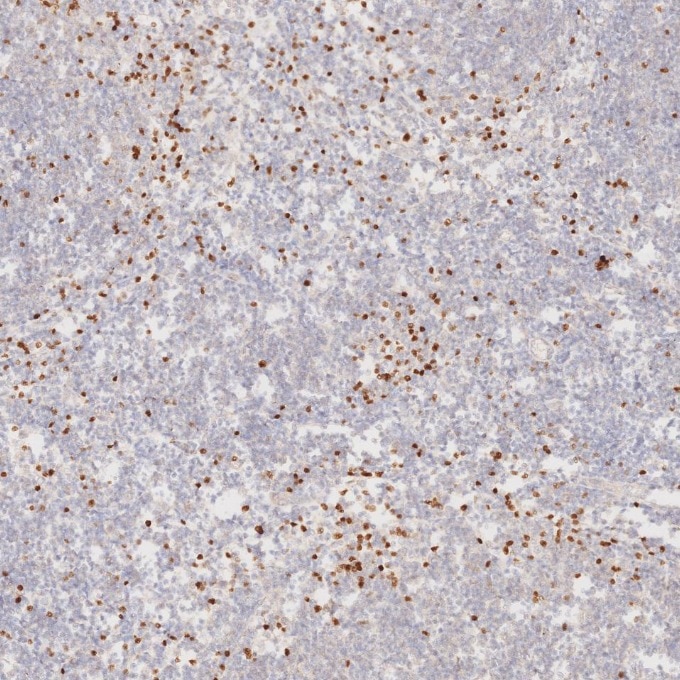 Immunohistochemistry (IHC) staining of human lymphoma tissue using FOXP3 Monoclonal antibody (68803-2-Ig)