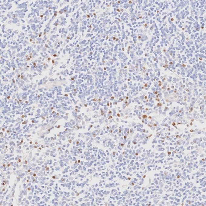 Immunohistochemistry (IHC) staining of human lymphoma tissue using FOXP3 Monoclonal antibody (68803-2-Ig)