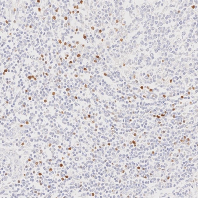 Immunohistochemistry (IHC) staining of human lymphoma tissue using FOXP3 Monoclonal antibody (68803-2-Ig)