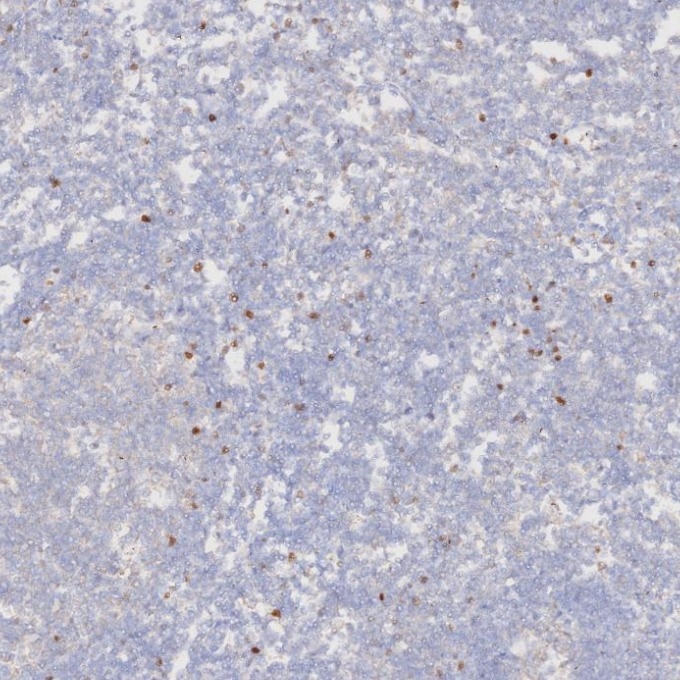 Immunohistochemistry (IHC) staining of human tonsillitis tissue using FOXP3 Monoclonal antibody (68803-2-Ig)
