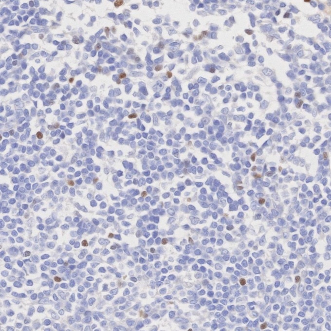Immunohistochemistry (IHC) staining of human tonsillitis tissue using FOXP3 Monoclonal antibody (68803-2-Ig)