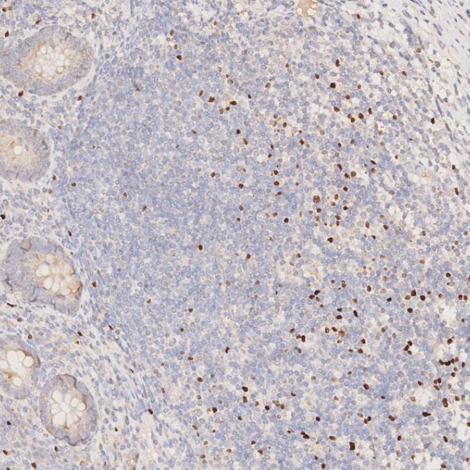 Immunohistochemistry (IHC) staining of human appendicitis tissue using FOXP3 Monoclonal antibody (68803-2-Ig)