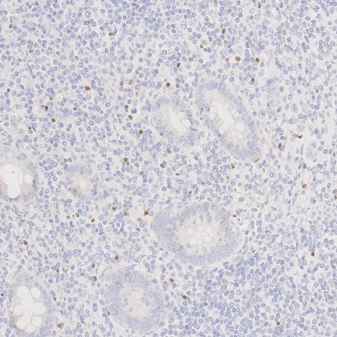 Immunohistochemistry (IHC) staining of human appendicitis tissue using FOXP3 Monoclonal antibody (68803-2-Ig)