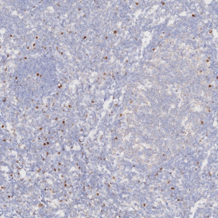 Immunohistochemistry (IHC) staining of human tonsillitis tissue using FOXP3 Monoclonal antibody (68803-2-Ig)
