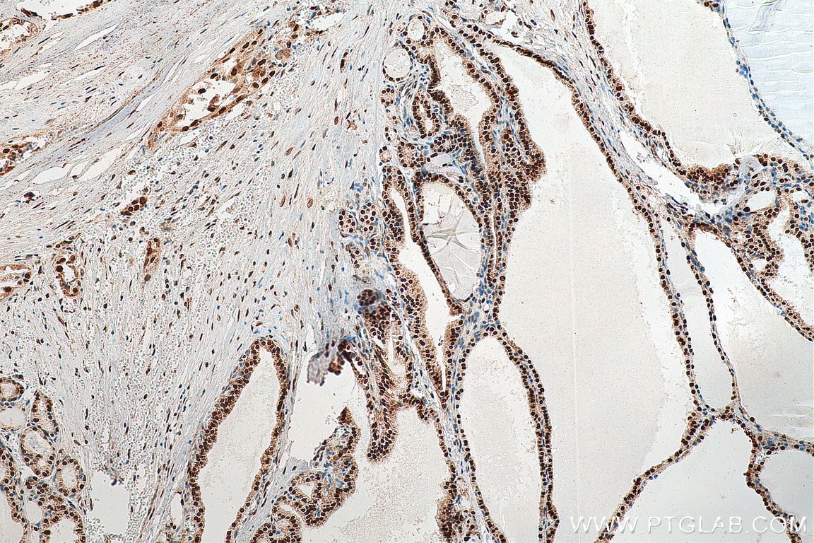 Immunohistochemistry (IHC) staining of human thyroid cancer tissue using FOXP4 Polyclonal antibody (16772-1-AP)