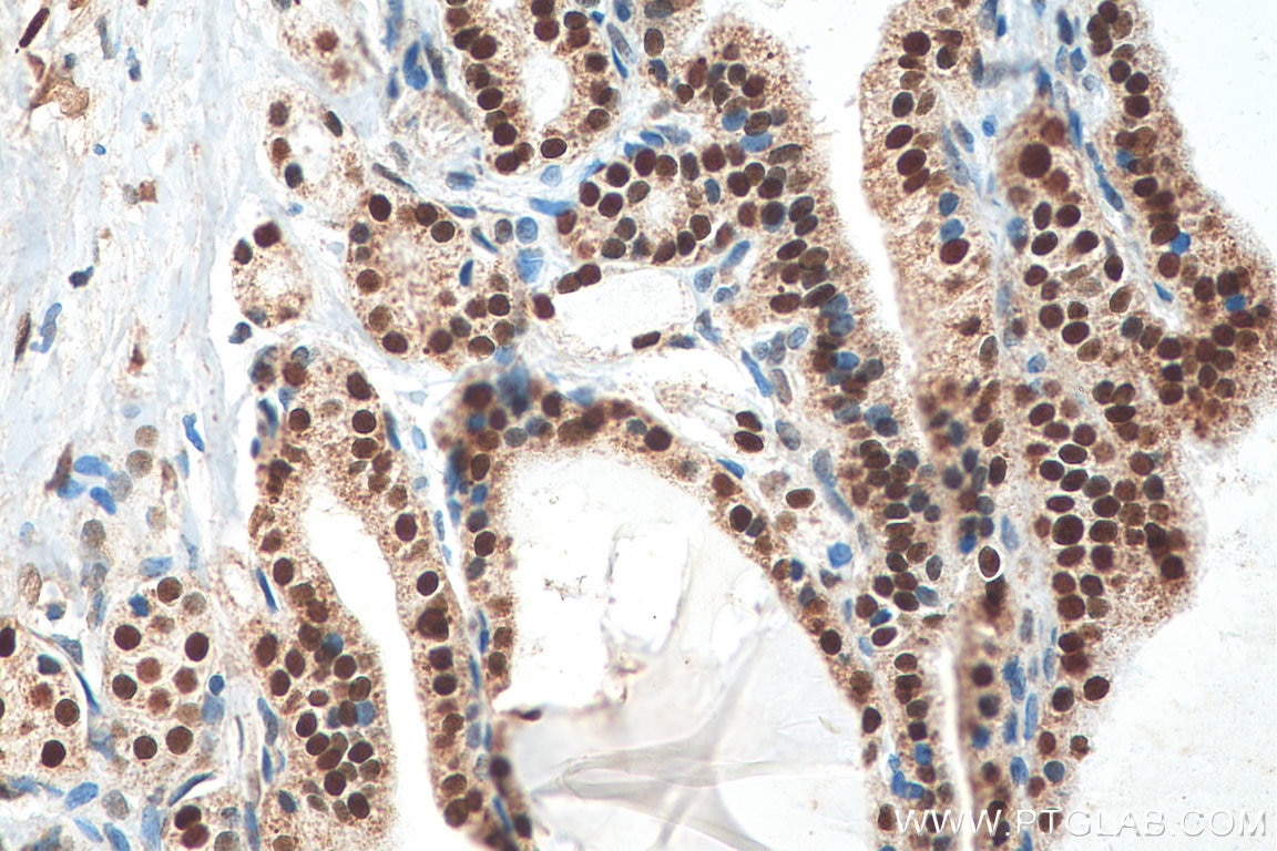 Immunohistochemistry (IHC) staining of human thyroid cancer tissue using FOXP4 Polyclonal antibody (16772-1-AP)