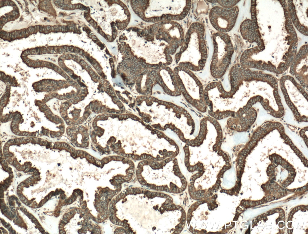 Immunohistochemistry (IHC) staining of human ovary tumor tissue using FOXRED1 Polyclonal antibody (24595-1-AP)
