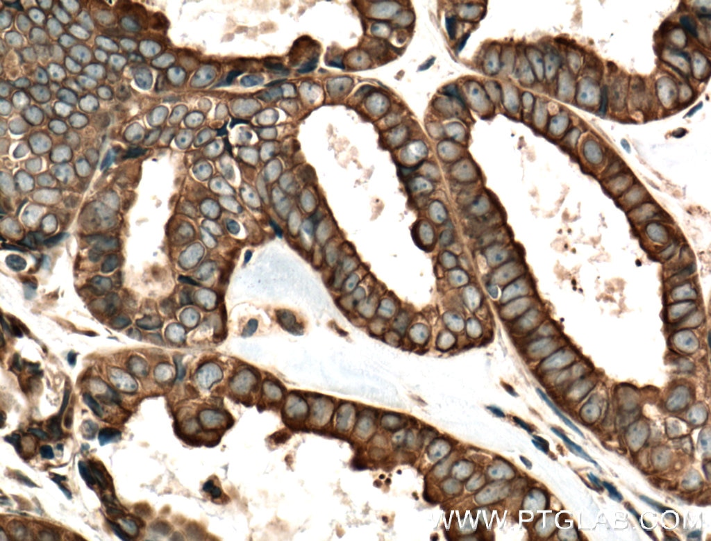 Immunohistochemistry (IHC) staining of human ovary tumor tissue using FOXRED1 Polyclonal antibody (24595-1-AP)