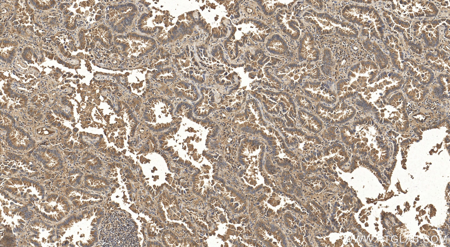 Immunohistochemistry (IHC) staining of human lung cancer tissue using FPGS Polyclonal antibody (27616-1-AP)