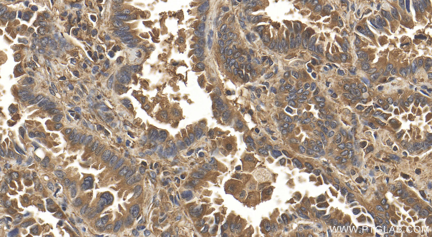 Immunohistochemistry (IHC) staining of human lung cancer tissue using FPGS Polyclonal antibody (27616-1-AP)