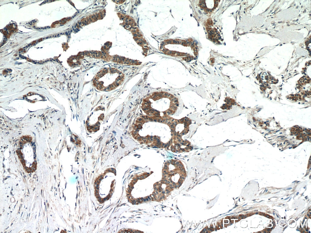 Immunohistochemistry (IHC) staining of human breast cancer tissue using FREM1 Polyclonal antibody (13086-1-AP)