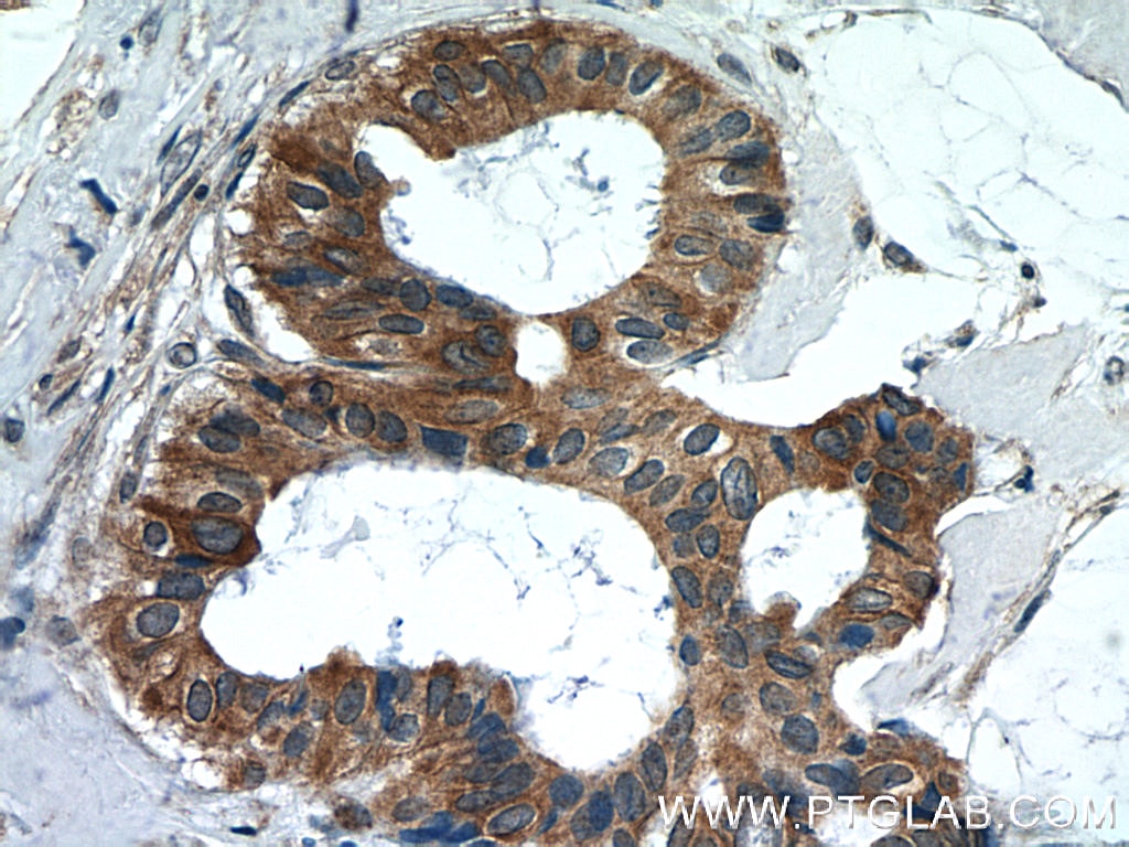 Immunohistochemistry (IHC) staining of human breast cancer tissue using FREM1 Polyclonal antibody (13086-1-AP)